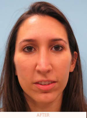 After nose surgery - Dr. Carlos L. Wolf