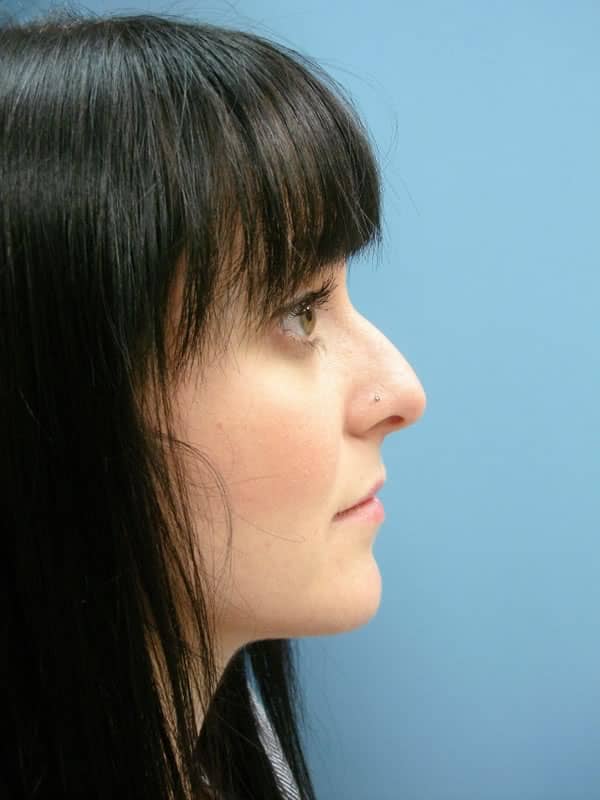 out of town rhinoplasty in miami with Dr. Carlos Wolf - Rhinoplasty before and after image