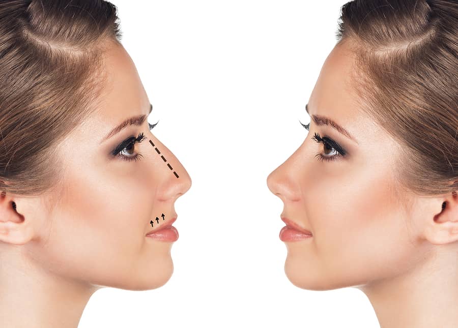rhinoplasty