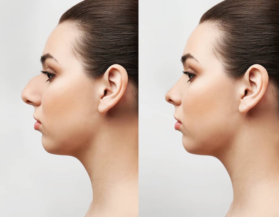 nose plastic surgery