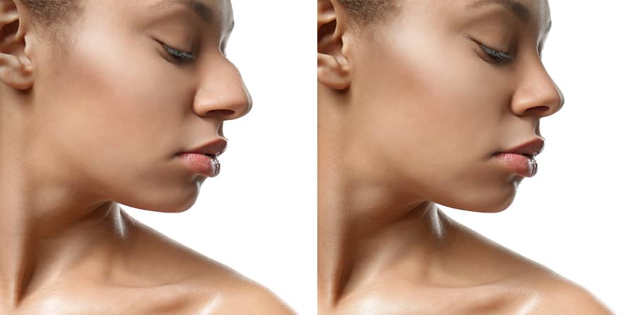 Revision Rhinoplasty Miami