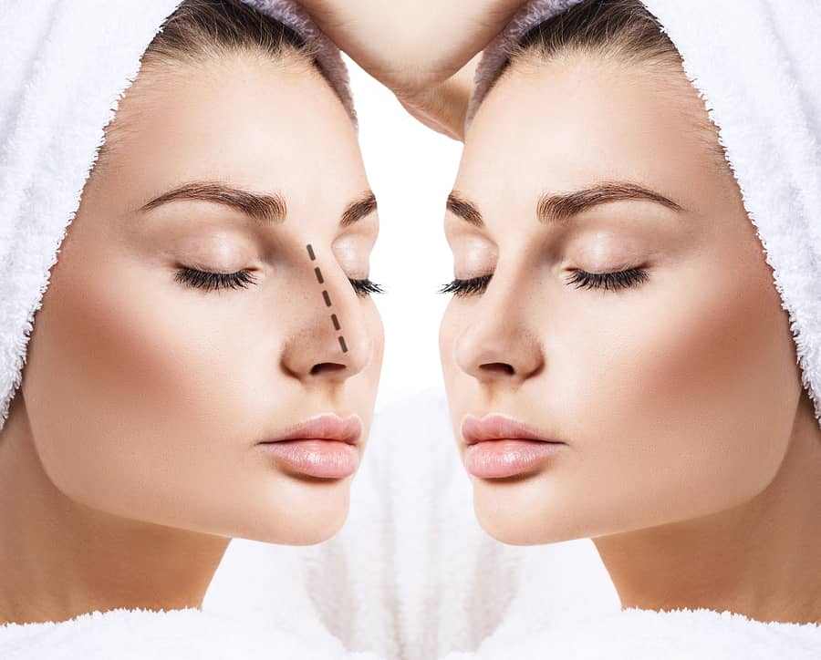 Two views of a woman's face in towel wraps, with a dotted line drawn along the bridge of the nose in one