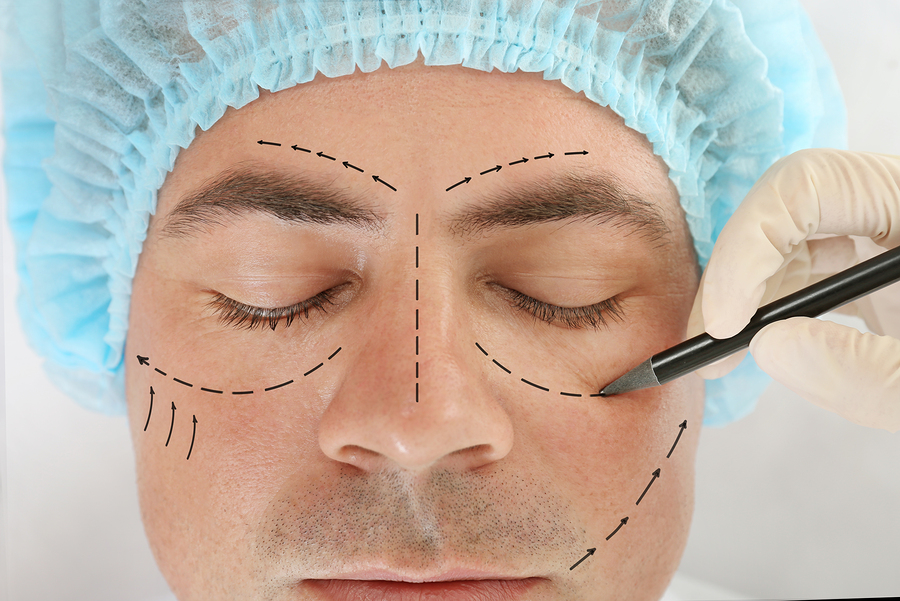 A man's face in a surgical cap with dashed marking lines drawn on his forehead, nose and cheeks as a gloved hand holds a pen