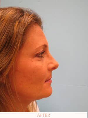 After Rhinoplasty - Dr. Carlos L. Wolf