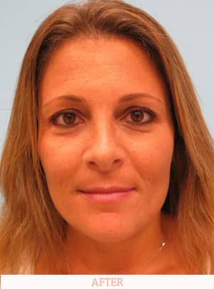 Miami rhinoplasty - Dr. Carlos Wolf - after image