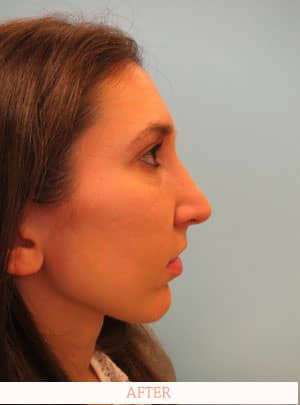 After nose surgery - Dr. Carlos L. Wolf