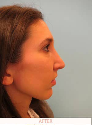 After Rhinoplasty - Dr. Carlos L. Wolf