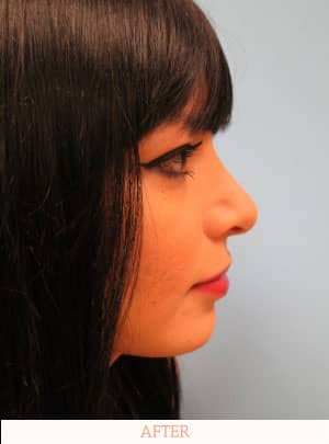 After Rhinoplasty image - Dr. Carlos L. Wolf