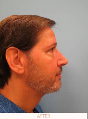 After Rhinoplasty - Dr. Carlos L. Wolf