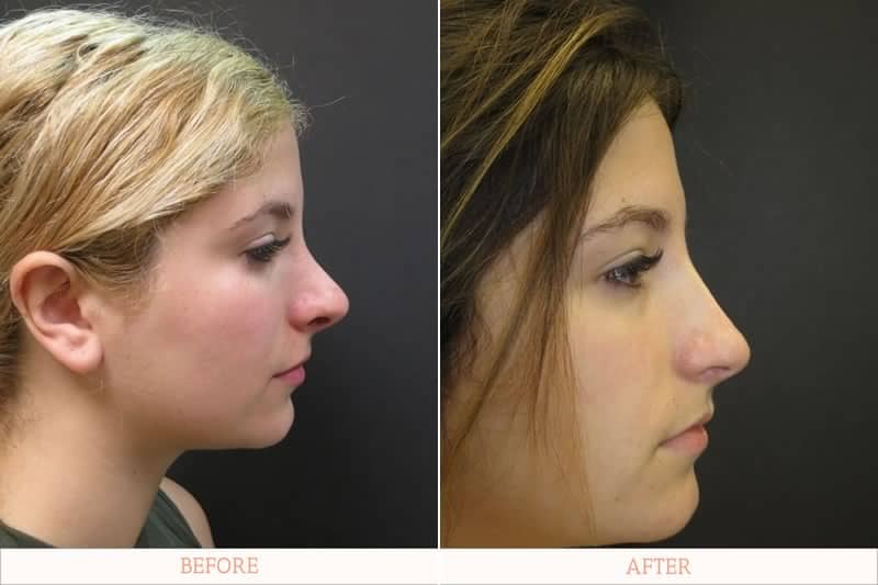 Before and after rhinoplasty images