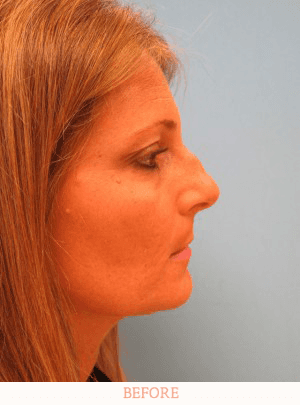 before rhinoplasty miami - Dr. Carlos Wolf