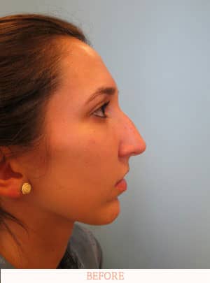 Before nose surgery - Dr. Carlos L. Wolf