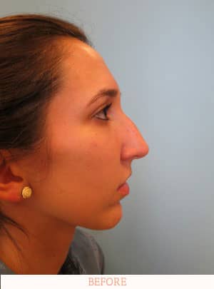 Before Rhinoplasty - Dr. Carlos L. Wolf