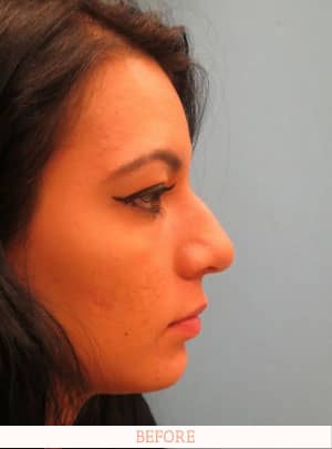 Before Rhinoplasty - Dr. Carlos L. Wolf