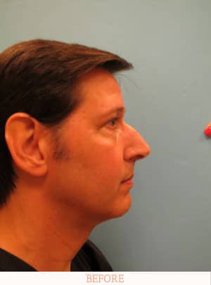 Before Rhinoplasty - Dr. Carlos L. Wolf