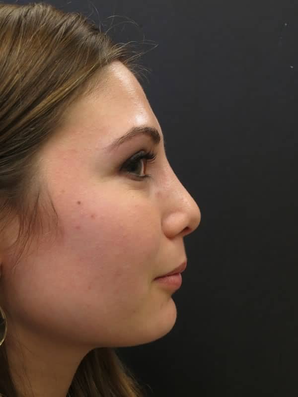Before and after Rhinoplasty - Dr. Carlos L. Wolf