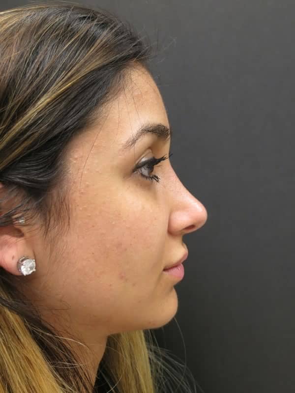 Before and after Rhinoplasty - Dr. Carlos L. Wolf