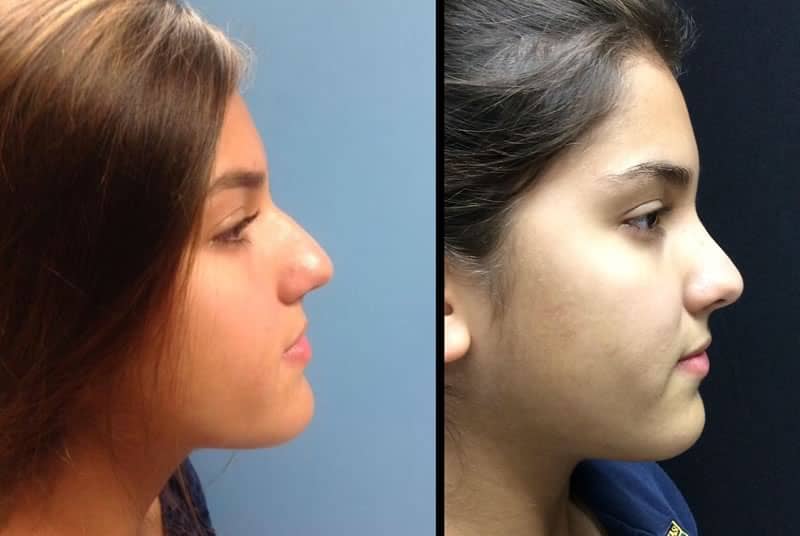 Before and After Rhinoplasty