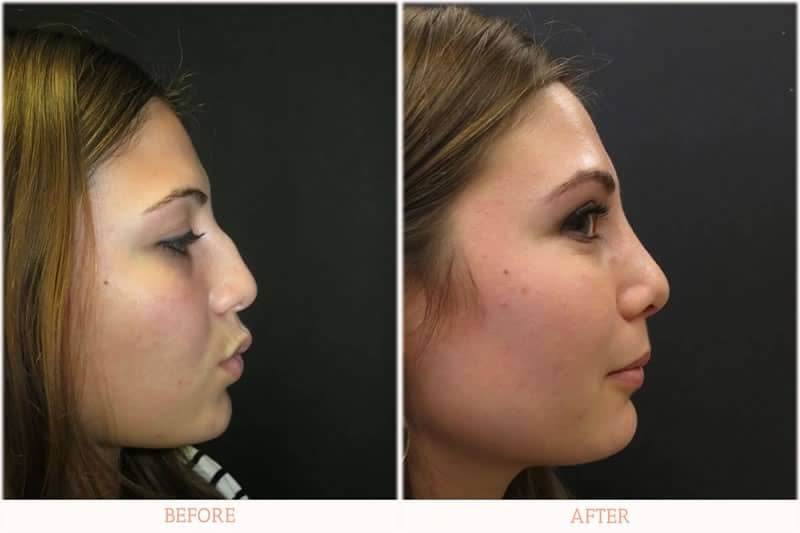 Before and after images nose surgery