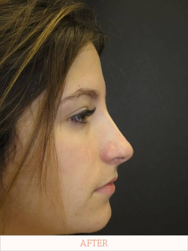 After Rhinoplasty - Dr. Carlos L. Wolf