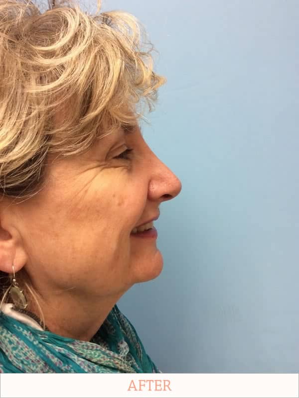 After Rhinoplasty - Dr. Carlos L. Wolf