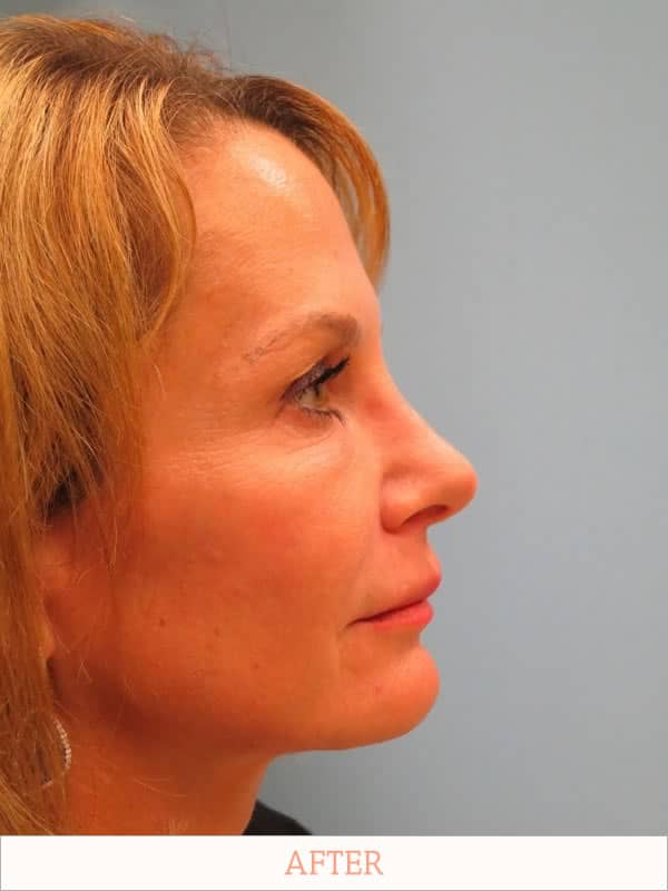 After: Rhinoplasty Recovery - Dr. Carlos Wolf