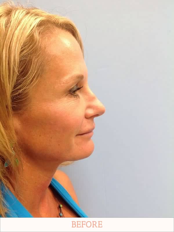 Before: Rhinoplasty Recovery - Dr. Carlos Wolf