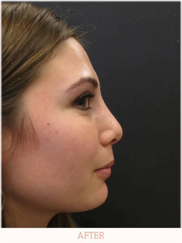 After - Revision Rhinoplasty - Dr. Carlos Wolf