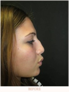 Before Rhinoplasty - Dr. Carlos Wolf