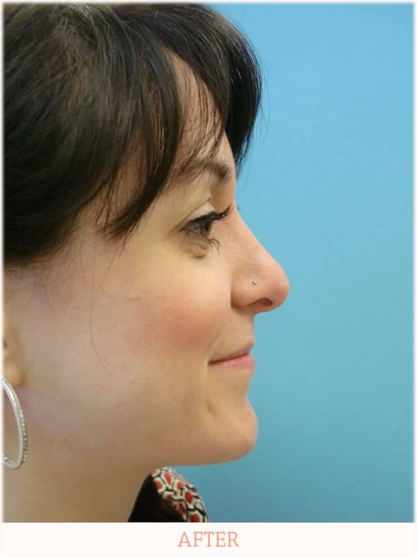 After Rhinoplasty - Dr. Carlos L. Wolf