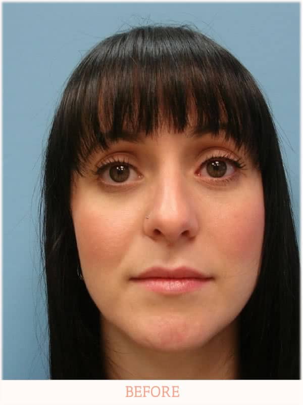 Before Rhinoplasty - Dr. Carlos L. Wolf