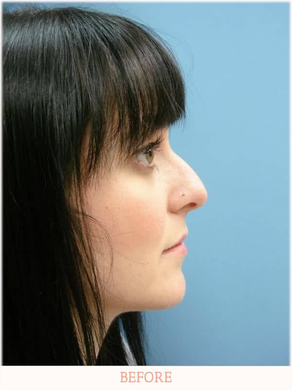 Before Rhinoplasty - Dr. Carlos L. Wolf