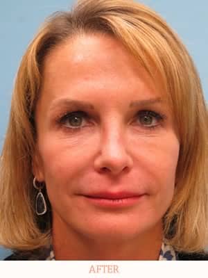 After Rhinoplasty - Dr. Carlos L. Wolf