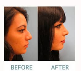 Nose Surgery Before and After 