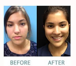 Rhinoplasty before and after - Dr. Carlos Wolf