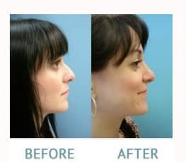 Miami Rhinoplasty before and after - Dr. Carlos Wolf