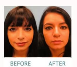 Rhinoplasty before and after images