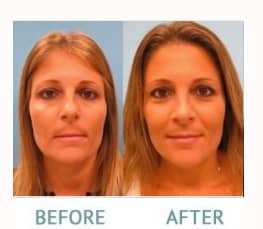 Rhinoplasty before and after