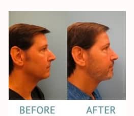 Male Rhinoplasty before and after Miami