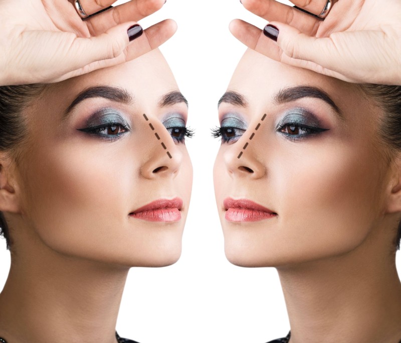 rhinoplasty surgery