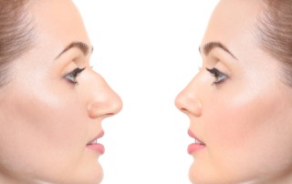 rhinoplasty