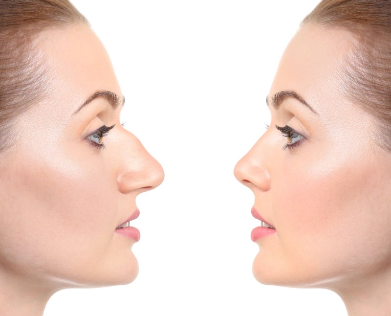 rhinoplasty