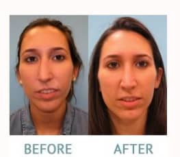 Rhinoplasty before and after Miami 