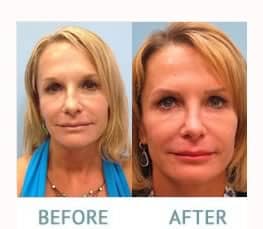 Rhinoplasty Recovery Miami 