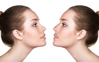 Rhinoplasty Procedure