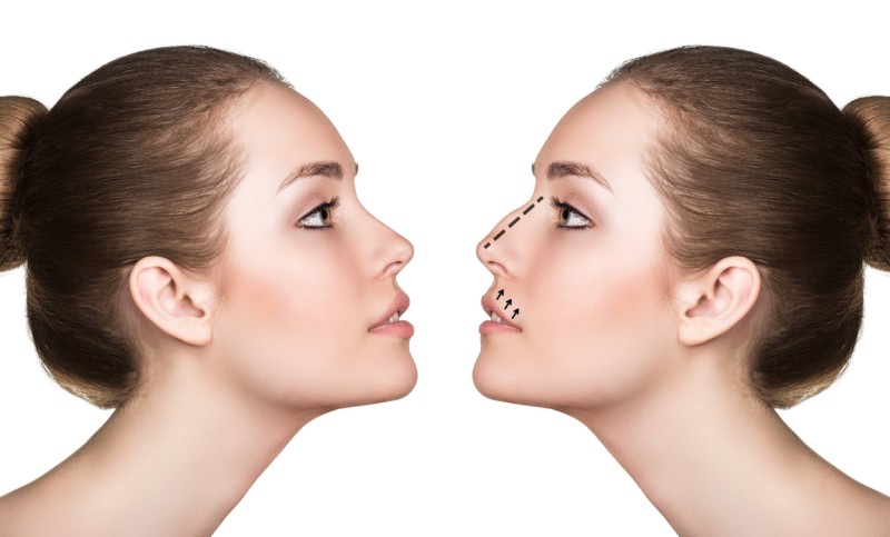 Rhinoplasty Procedure