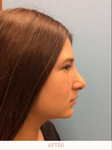 Profile after rhinoplasty