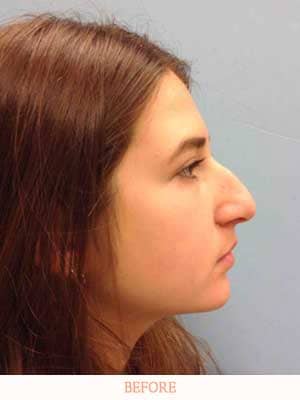 before rhinoplasty