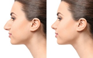 Rhinoplasty Procedure