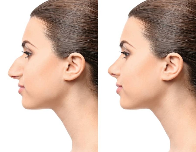 Rhinoplasty Procedure